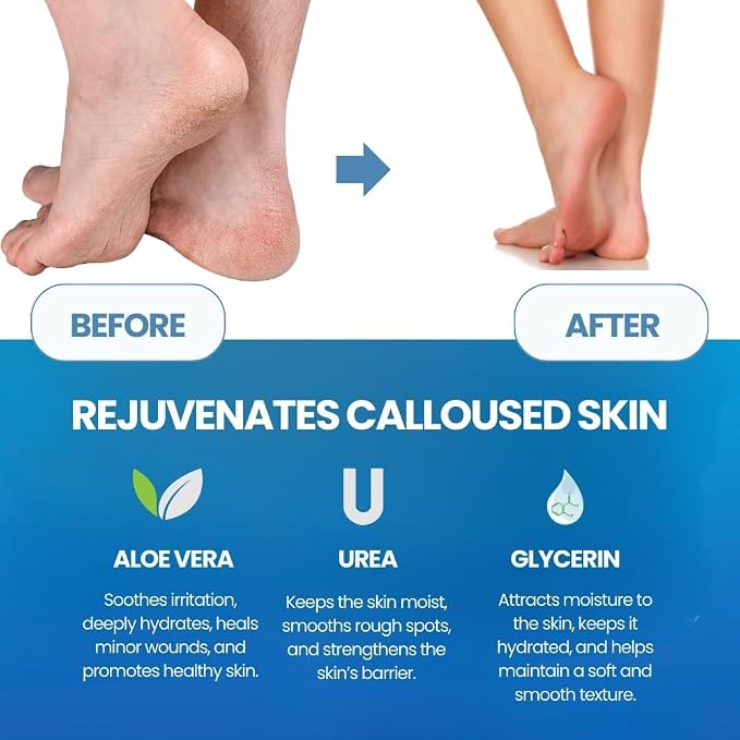 Callus Remover