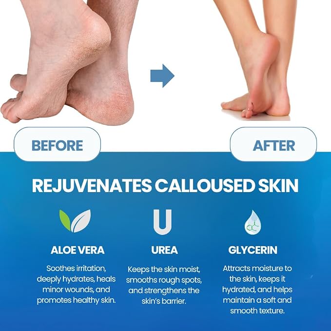 Callus Remover With File
