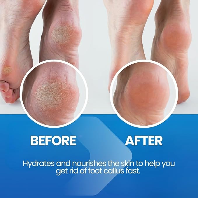 Callus Remover