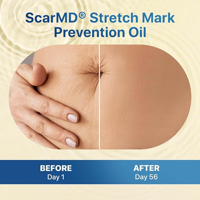 4.06 f oz Stretch Mark Oil