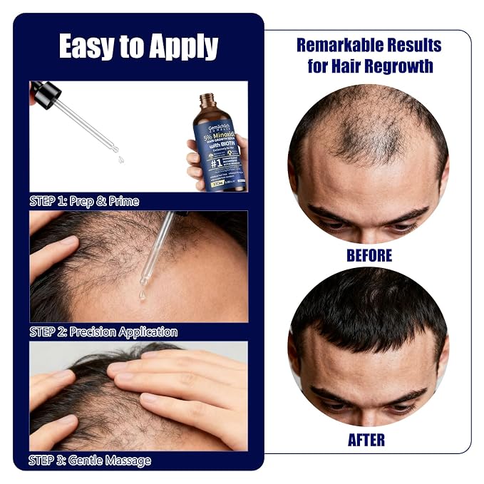 5% Minoxidil